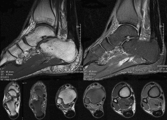 Management of post-surgical Achilles tendon complications with a preparationrich in growth factors: A study of two-cases